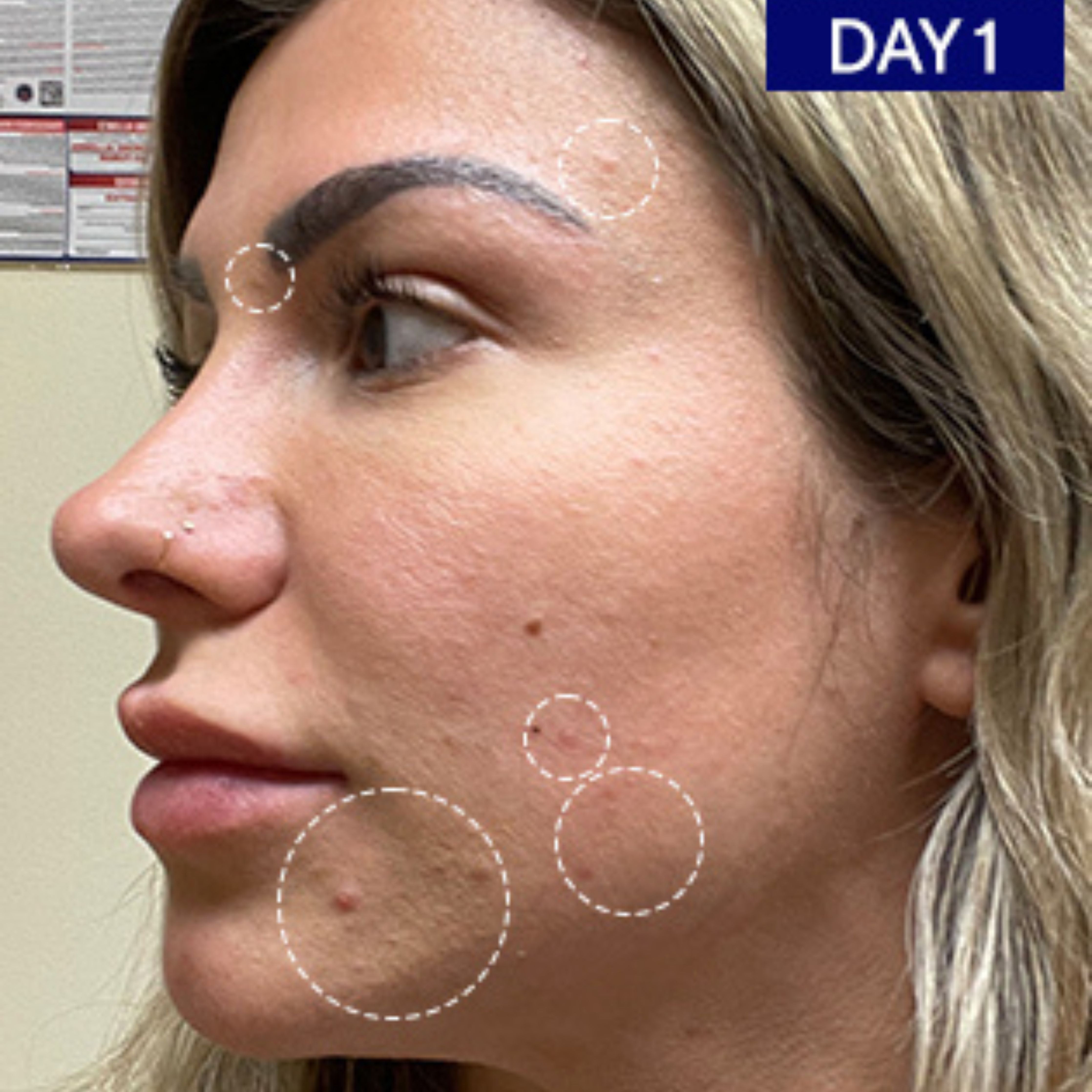 Sérum visage régulateur à l'acide salicylique et à l'acide hyaluronique