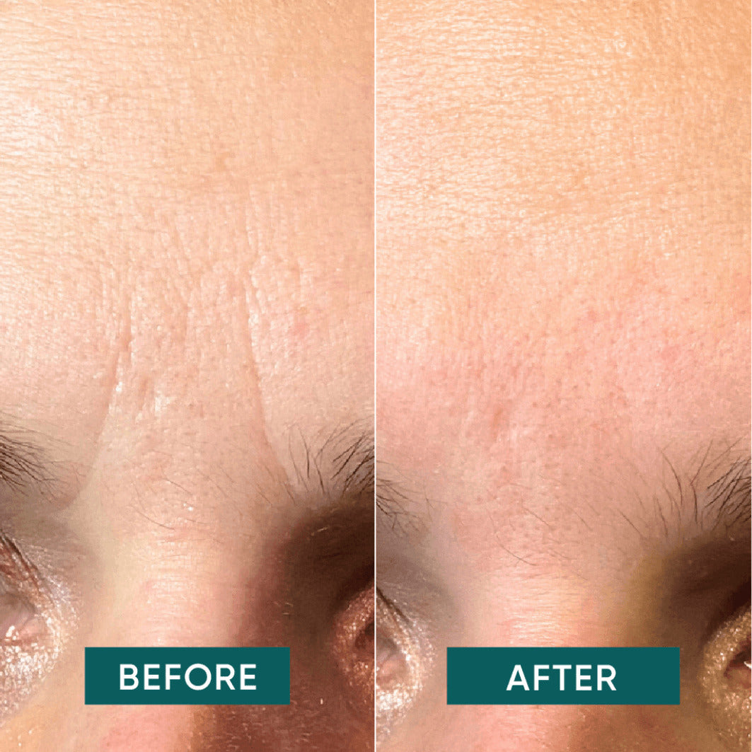 Parches para ceño y frente con ácido hialurónico Down the Frown