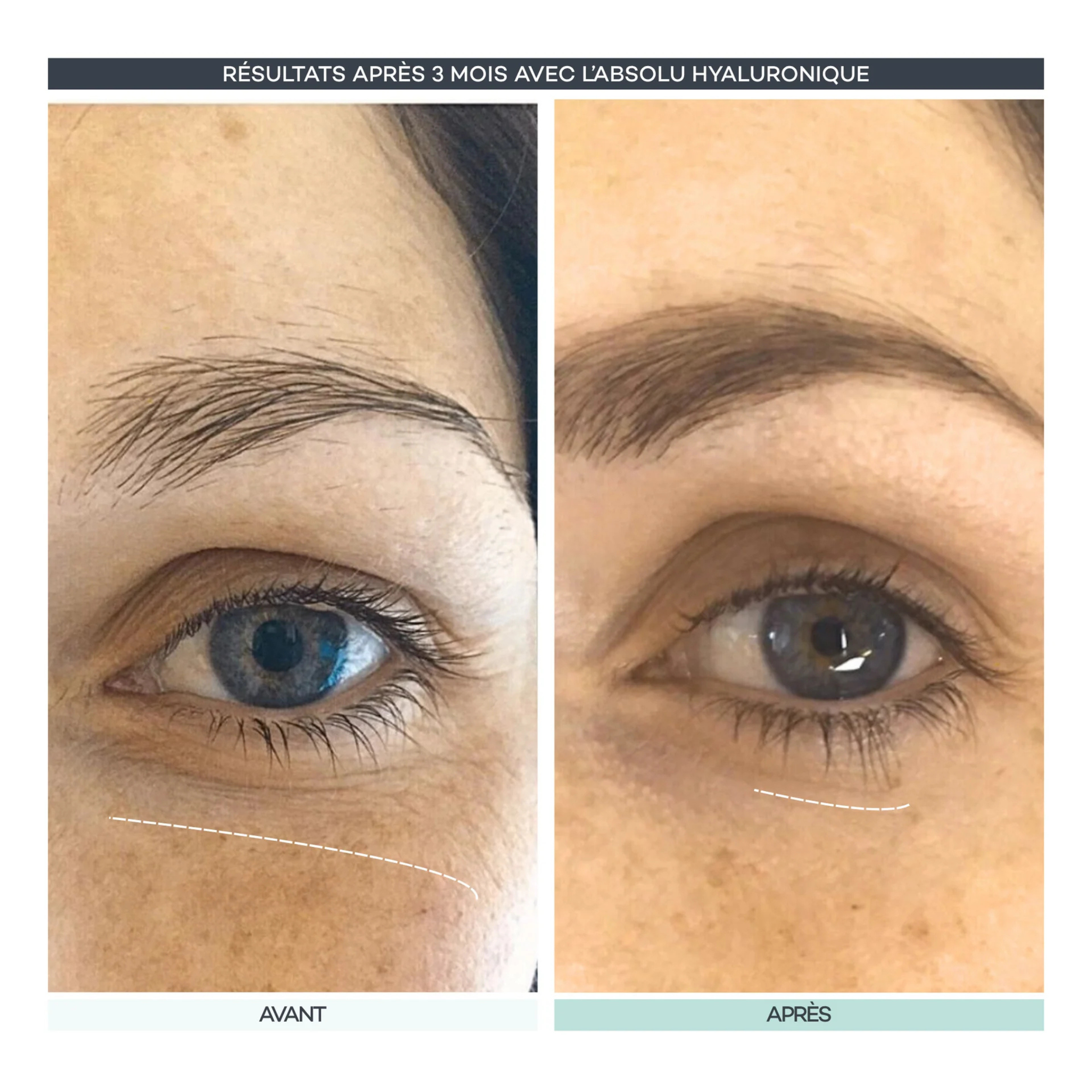 Absolute hyaluronic acid capsules