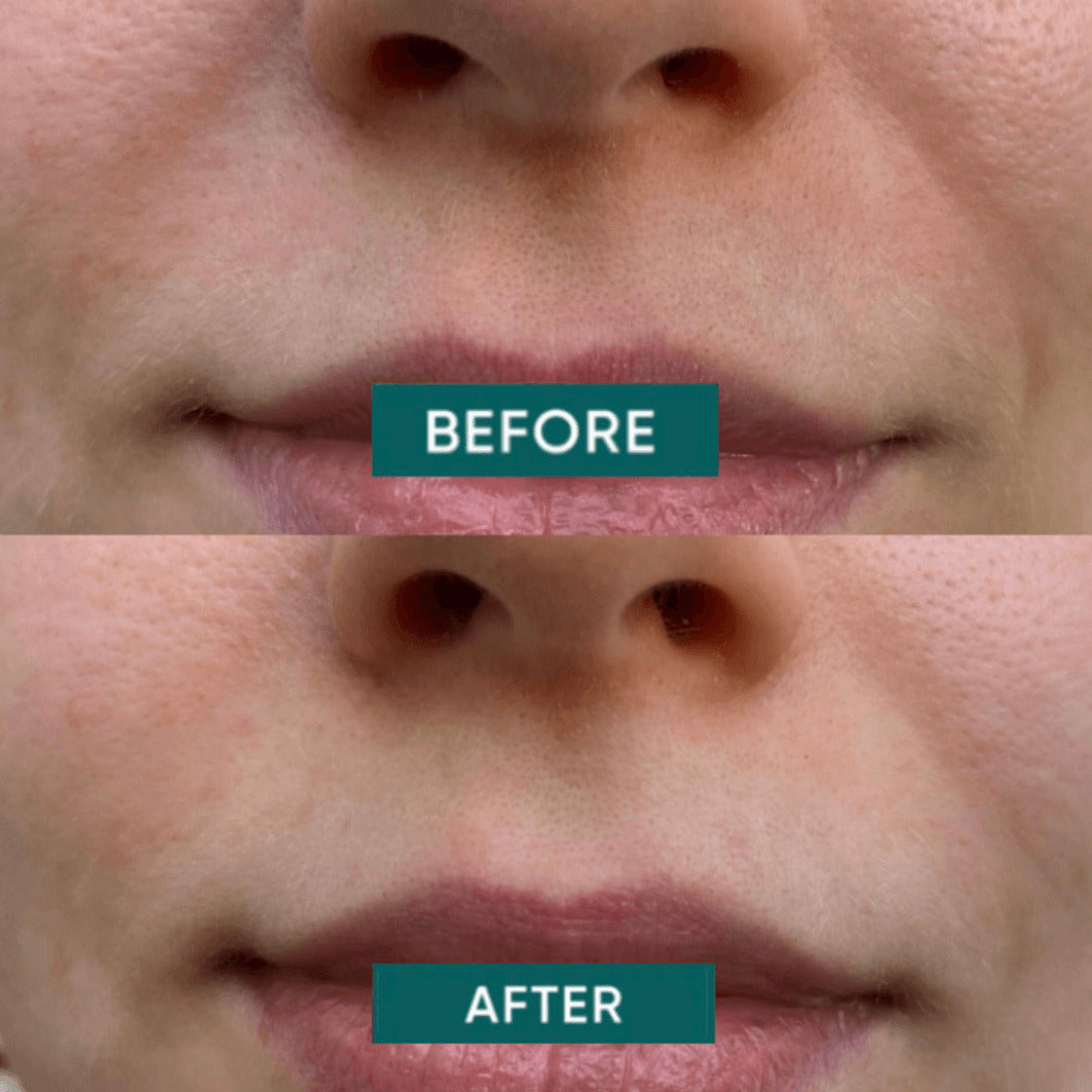 Keep Smiling Hyaluronic Acid Lip Patches